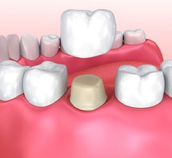 Image of all-ceramic dental crown.