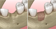 jawbone before and after bone grafting in Lovell