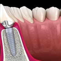 side view of a dental implant in the lower jaw
