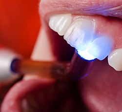 Direct bonding dental procedure. 