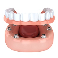 Dentures in Lovell, WY about to be placed on dental implants