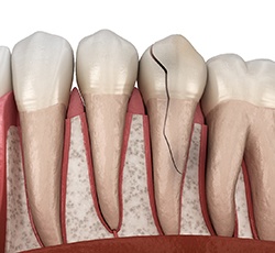 3D render of a broken tooth