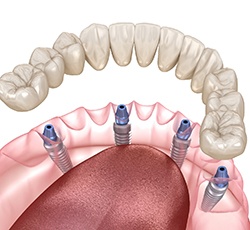 Illustration of implant dentures for lower dental arch