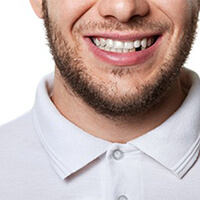 A person with a missing tooth