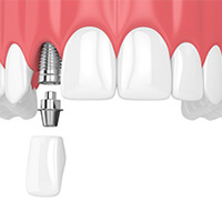A diagram highlighting the parts of a dental implant
