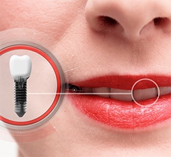 Picture of a dental implant next to a patient’s mouth