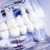 A model of a series of dental implants