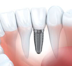 A diagram of an integrated dental implant