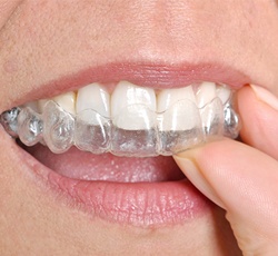 Woman wearing Invisalign