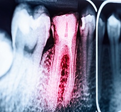 X-ray of root canal treated tooth