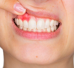 Patient with damaged gum tissue