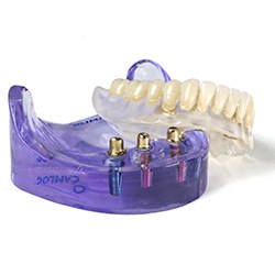 Implant supported denture model