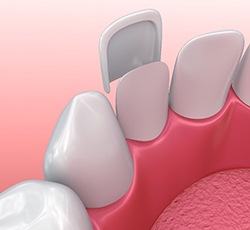 diagram of porcelain veneers in Lovell