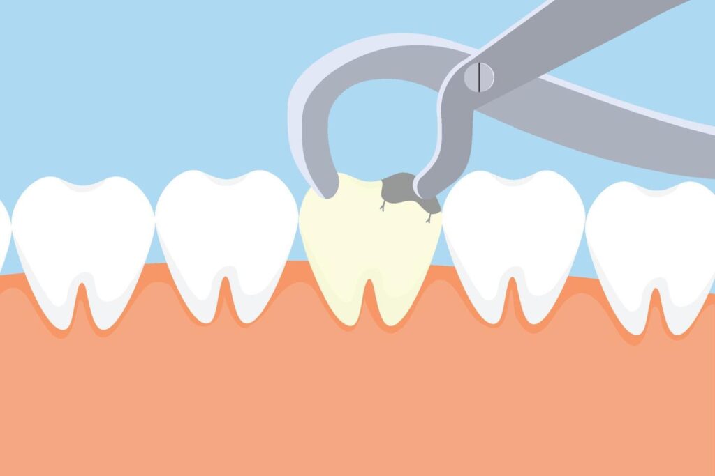 art of tooth extraction