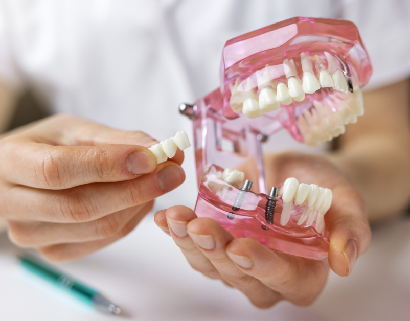 Hands holding model dental implant